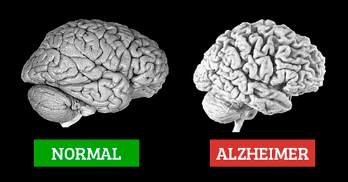 آلزایمر آلزهایمر متخصص مغز و اعصاب دکتر مغز و اعصاب پزشک مغز و اعصاب دکتر عباسیون